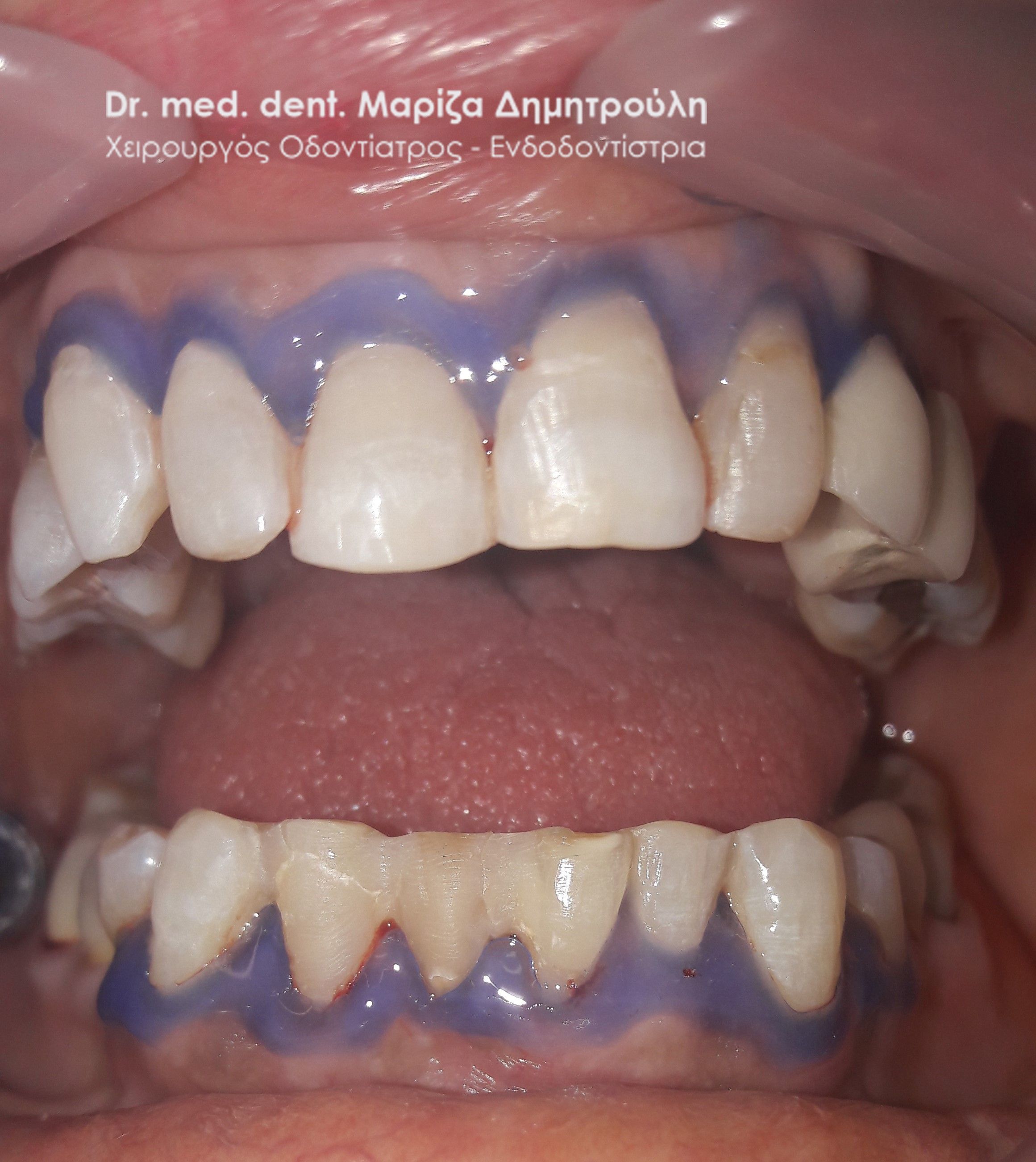 λευκανση οδοντιατρος θεσσαλονικη λευκανση 11