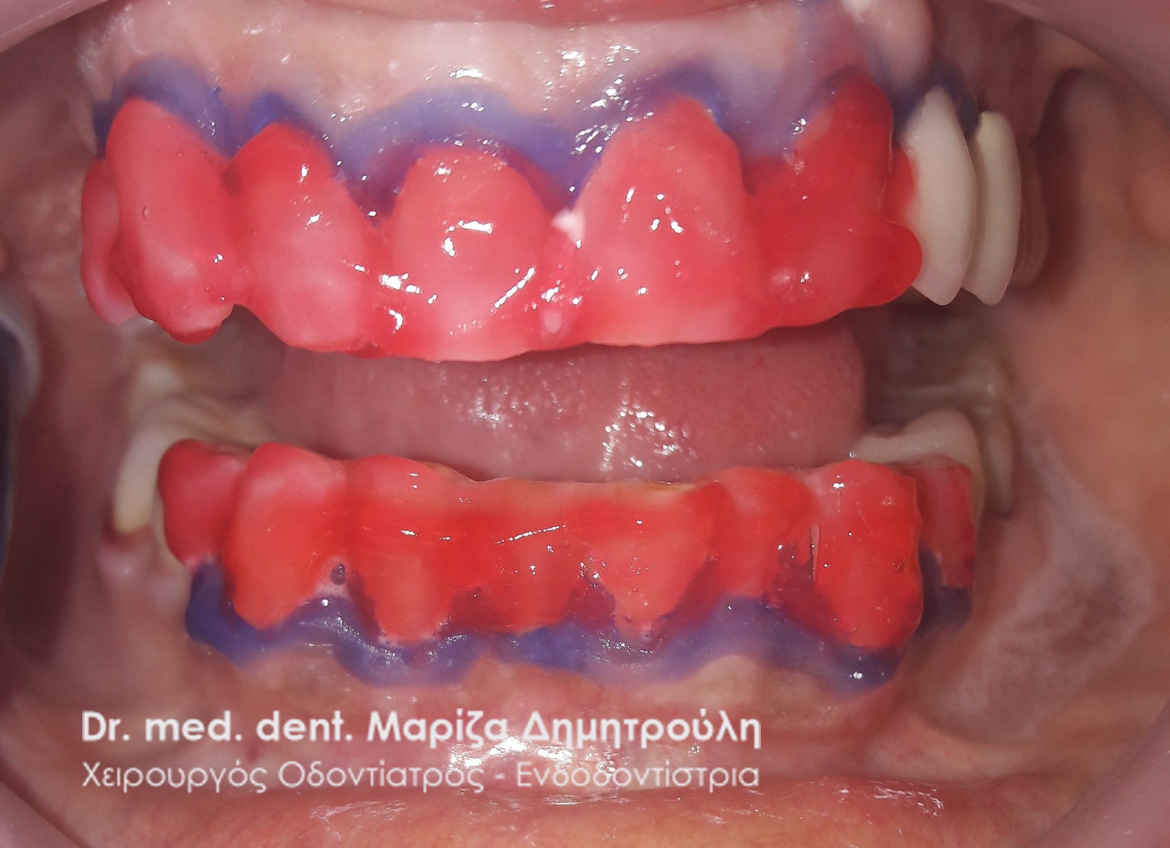 λευκανση οδοντιατρος θεσσαλονικη λευκανση 22