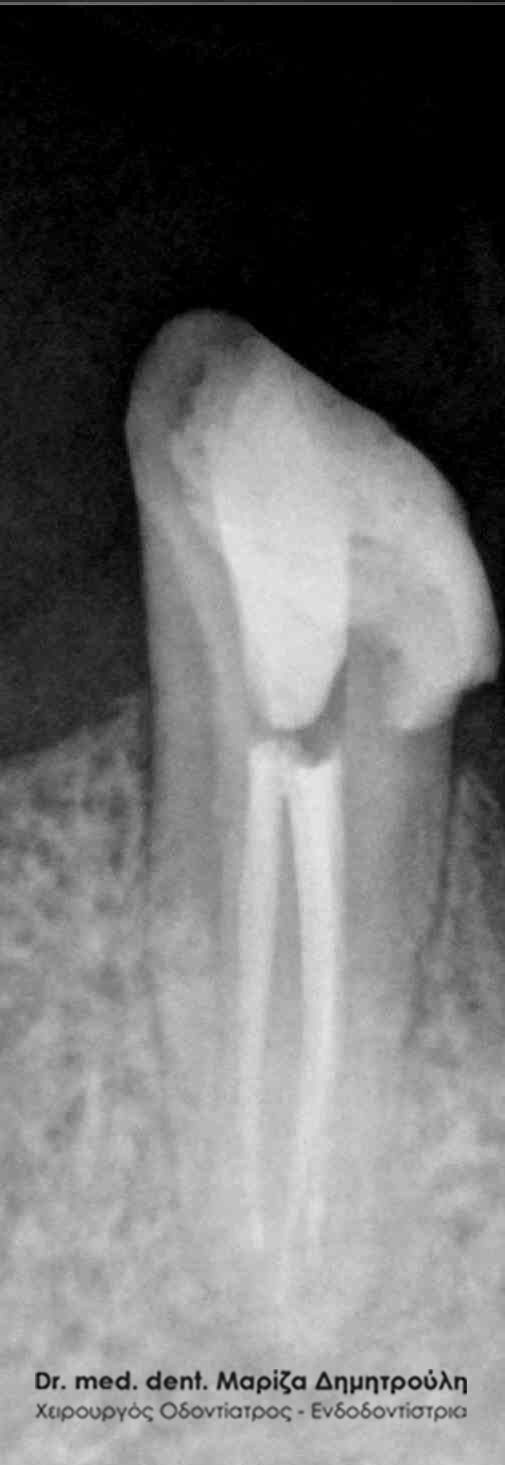 Απονεύρωση δοντιού