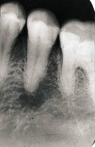 Ενδοδοντολόγος Θεσσαλονίκη