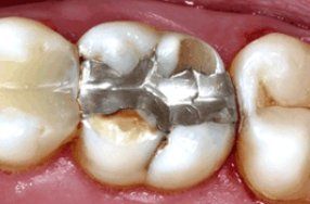 Insufficient filling