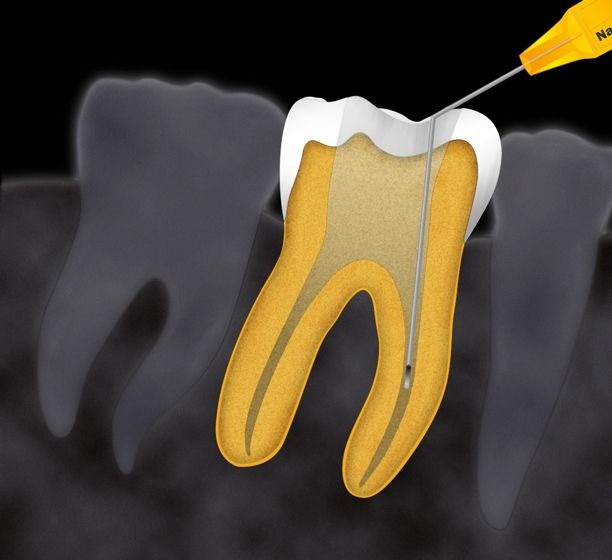Απονεύρωση δοντιού