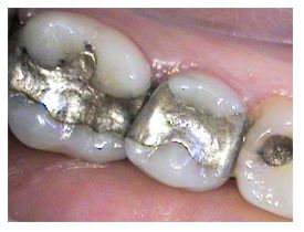 amalgamfilling