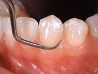 καθαρισμός δοντιών