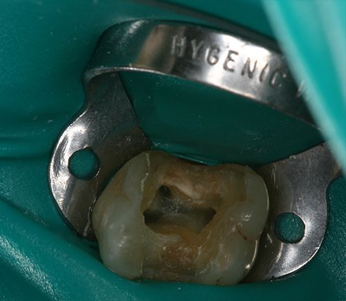 Ενδοδοντολόγος Θεσσαλονίκη